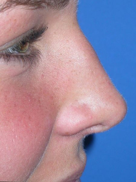 Rhinoplasty