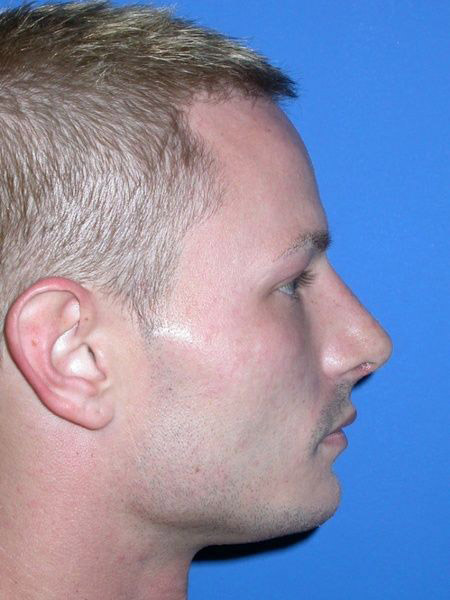 chin augmentation