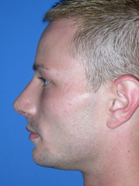 chin augmentation