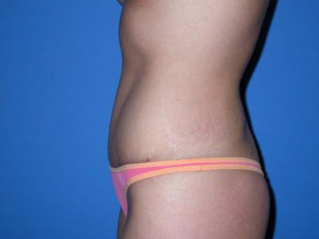 after abdominoplasty