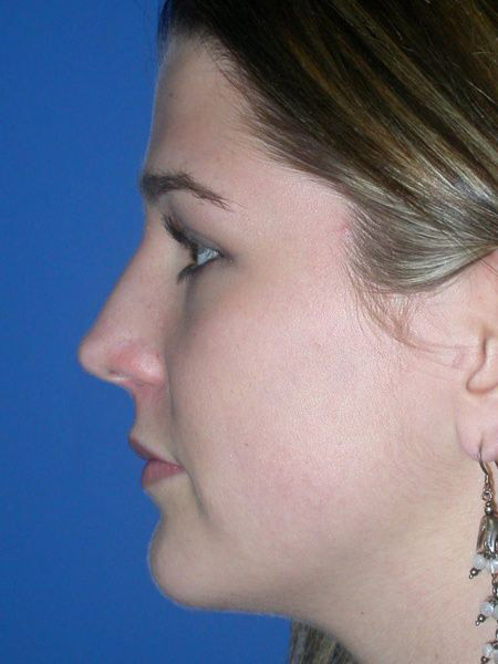 Rhinoplasty