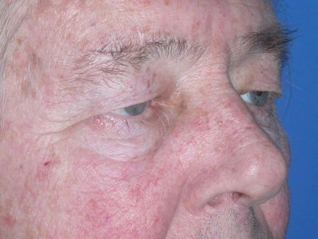 blepharoplasty