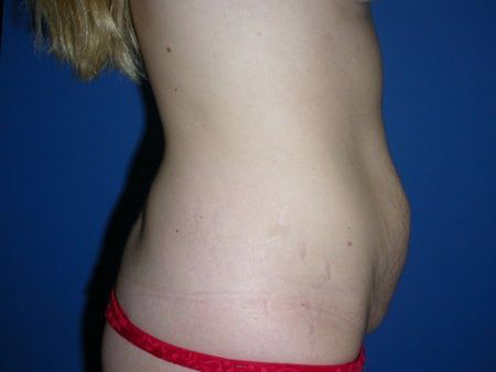 before abdominoplasty