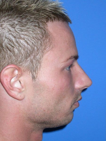 chin augmentation