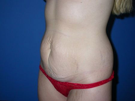 before abdominoplasty
