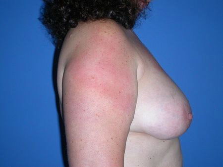 breast reconstruction