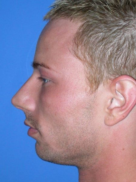 chin augmentation