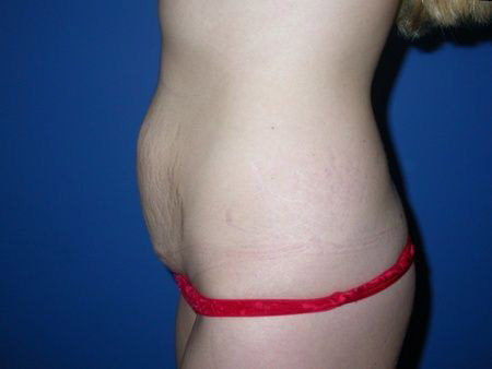 before abdominoplasty