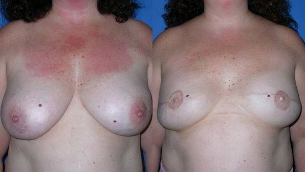 before and after breast reconstruction